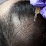 Stem Cell Therapy in Androgenic Alopecia