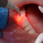 آینده درخشان استفاده از پلاسما سرد در حوزه دندان پزشکی