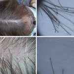 Telogen Effluvium after COVID Infection