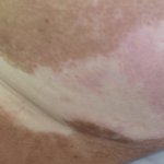 Vitiligo Like Lesions in a Patient with Metastatic Breast Cancer Treated