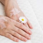 Combined Treatment for Vitiligo in Different Body