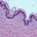 Pilot Study of Histology Aspect of Cellulite in Seventy Patients who Differ in BMI and Cellulite Grading