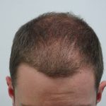 Hair Transplantation Surgery Versus Other Modalities of Treatment in Androgenetic Alopecia