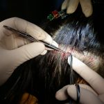 Long Hair Follicular Unit Excision