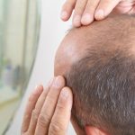 The Effect of Hyperbaric Oxygen Therapy Combined with Hair Transplantation Surgery