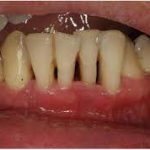 Ozone<br>Gas in a Patient with Aggressive Periodontitis