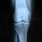 The Role of PEMFs on Bone Healing